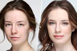 Средство Bioaqua Anti Acne нормализует секрецию сальных желёз с первого применения.