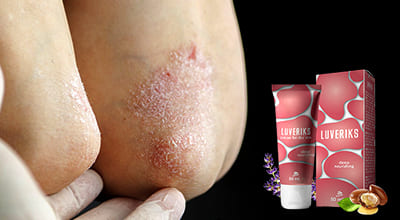 luveriks-ot-psoriaza